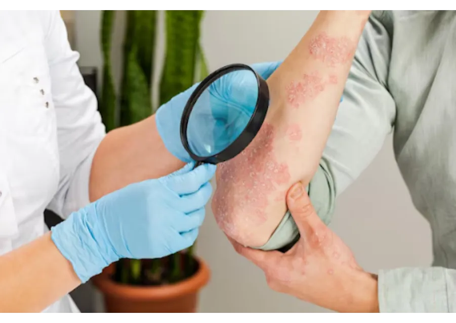 Psoriasis Treatment in Aundh, Pune for Long-Term Relief