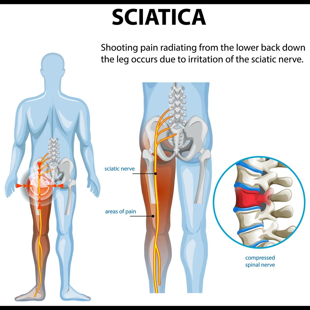 Lasting Relief from Sciatica in Noida with Specialised Care