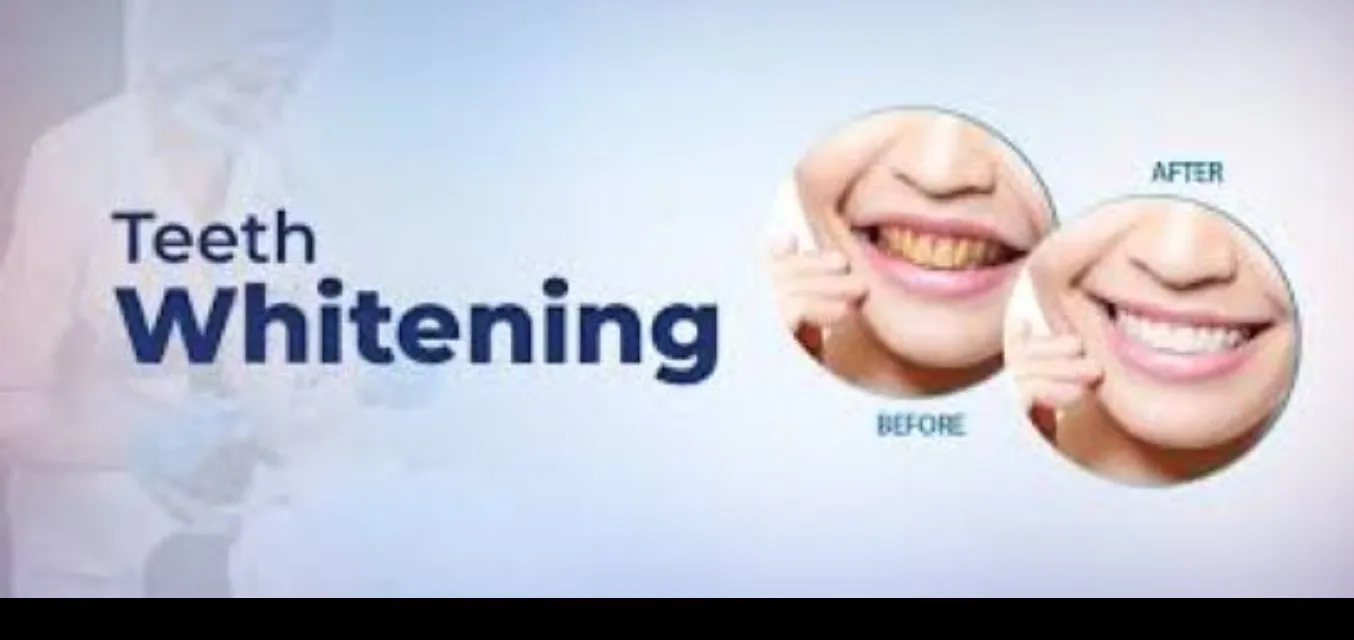 Best Teeth Whitening Clinic in Greater Noida West – P.D. Dental