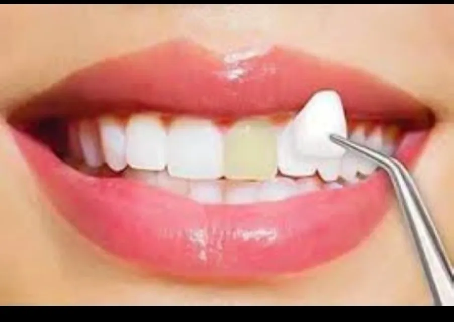 Dental Veneers Treatment in Dhule|Gindodia Hospital