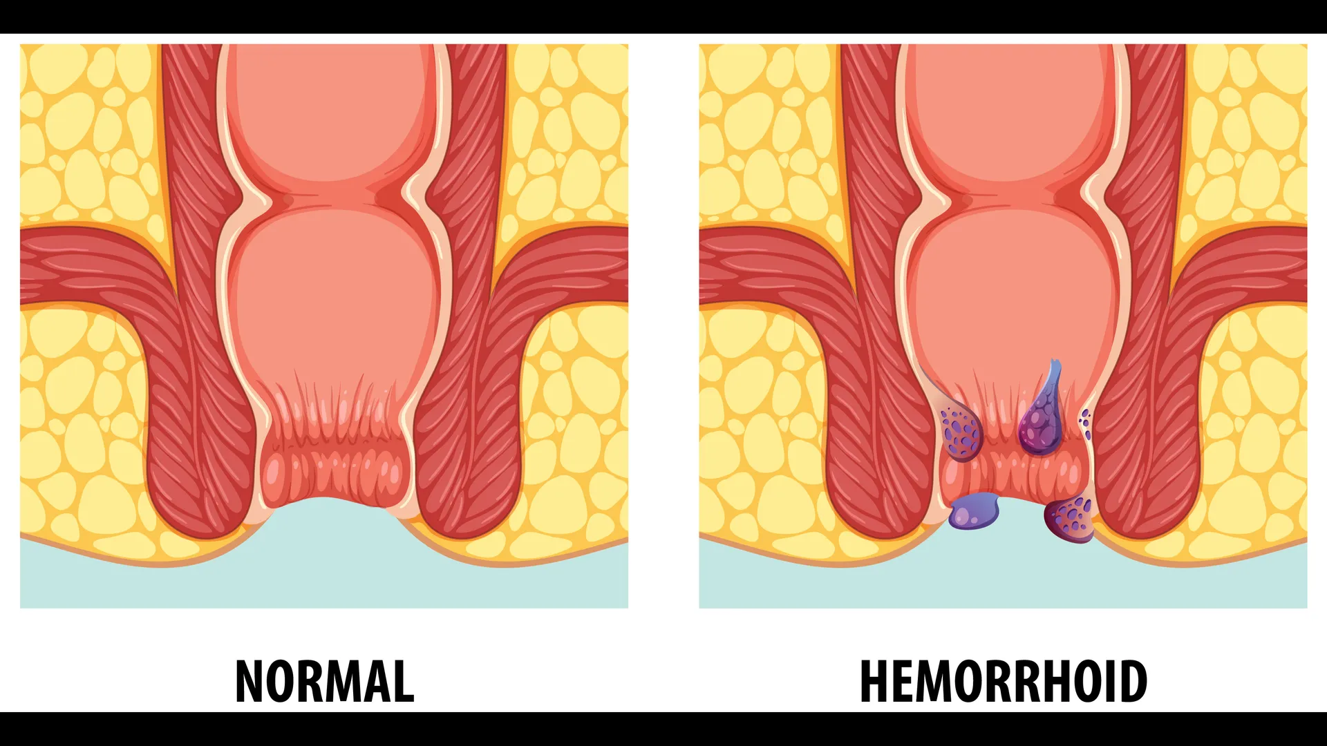 Hemorrhoid Specialist in Byculla – Expert Care for Lasting Relief