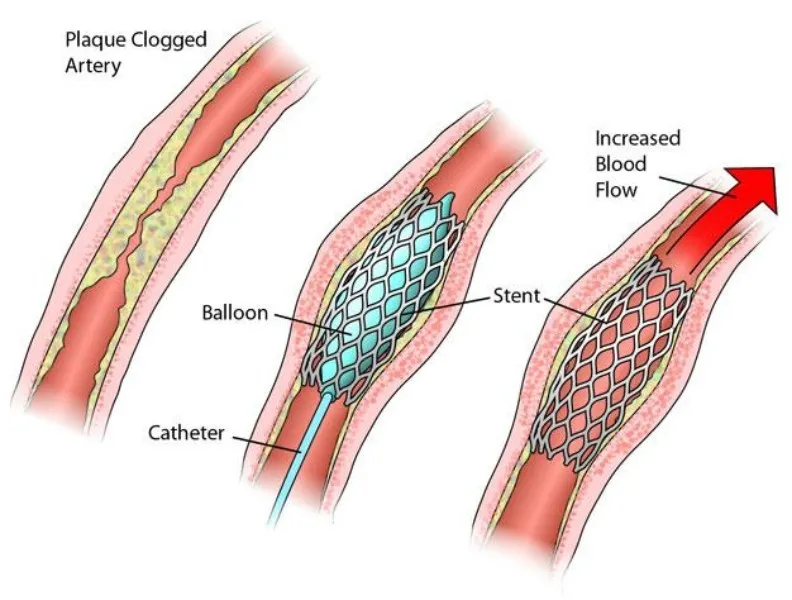 Angioplasty Procedure in Aundh – Restoring Blood Flow, Protecting Lives