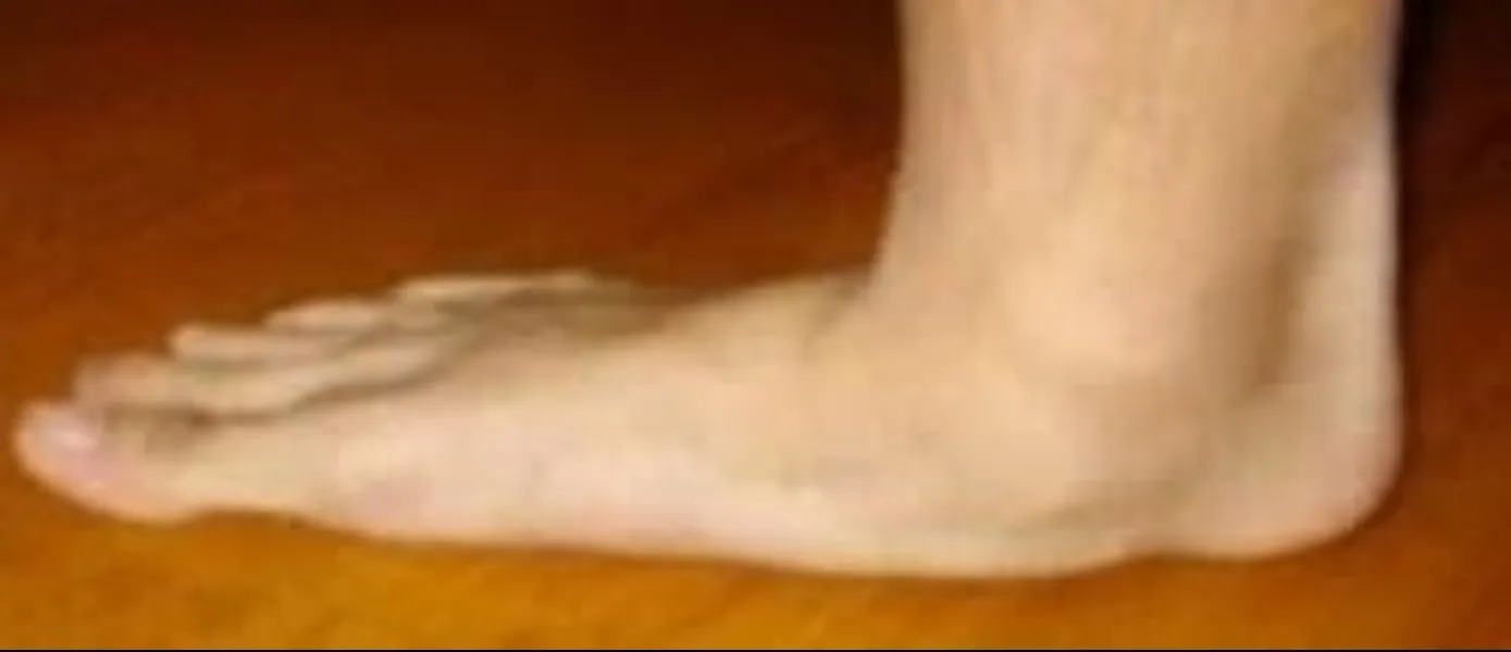 Flatfoot Specialist in Nagpur – Comprehensive Foot Care