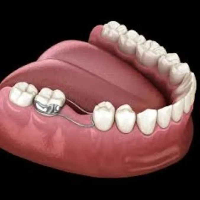 Space Maintainer Treatment in Dhule | Expert Pediatric Dental Care