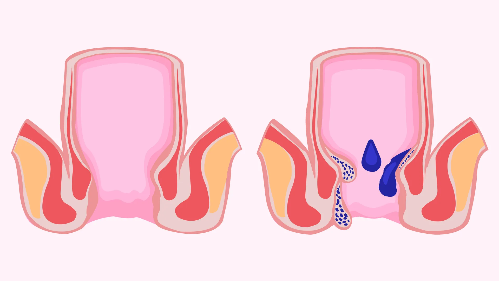 Piles Treatment Doctor in Surana Sethia – Safe and Effective Solutions