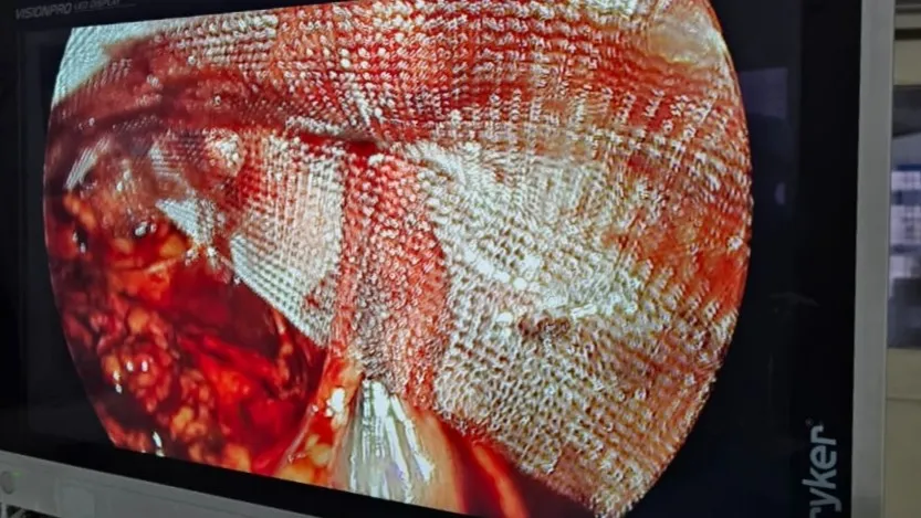 Irreducible inguinal hernia managed laparoscopically