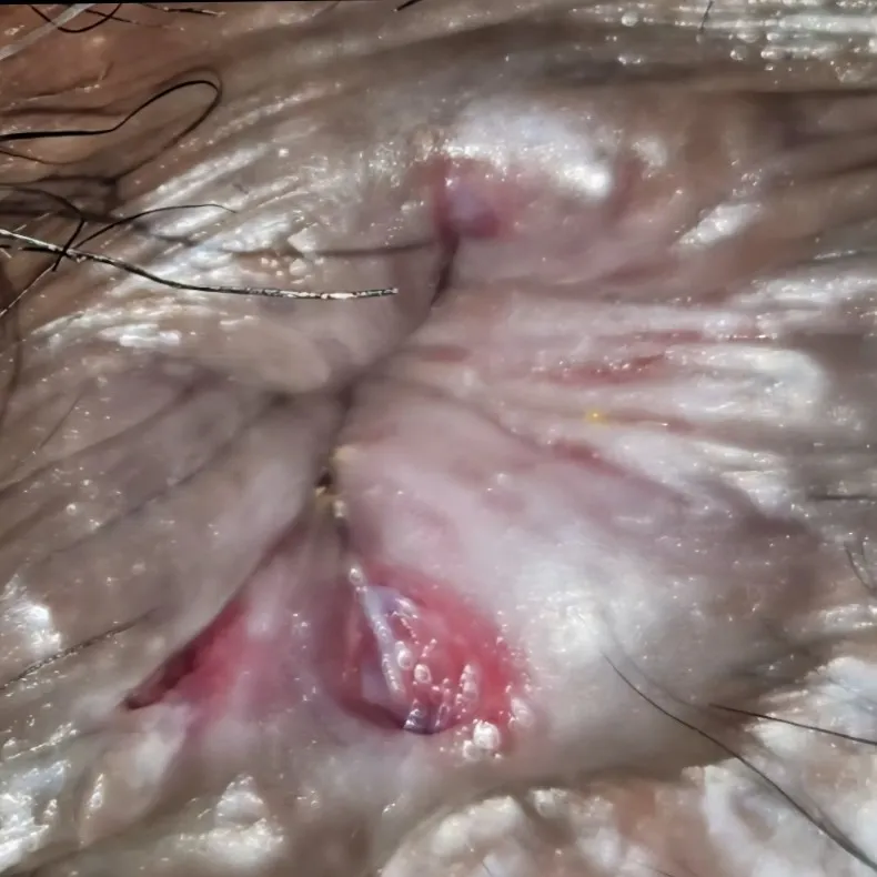 Best Anal Fissure treatment in Malad East