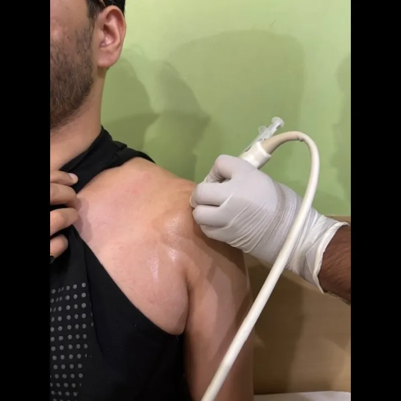 GFC injection for shoulder pain (Tendinosis)