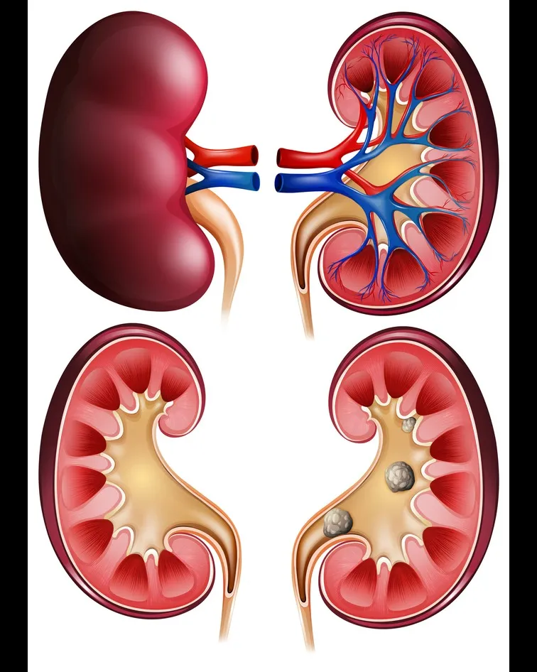 Kidney Stone Surgeon in Thane West: Experienced Hands, Proven Results