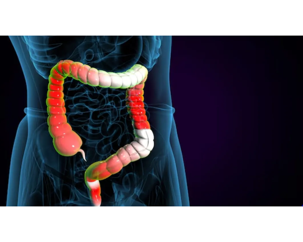 Ulcerative Colitis Care in Mumbai