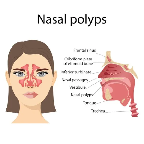 Nasal Polyposis Surgery in Nashik