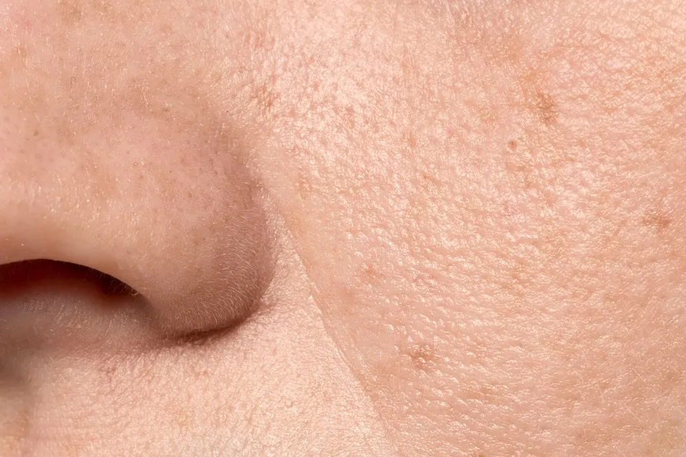 Open Pores Treatment In Chennai With Visible Results