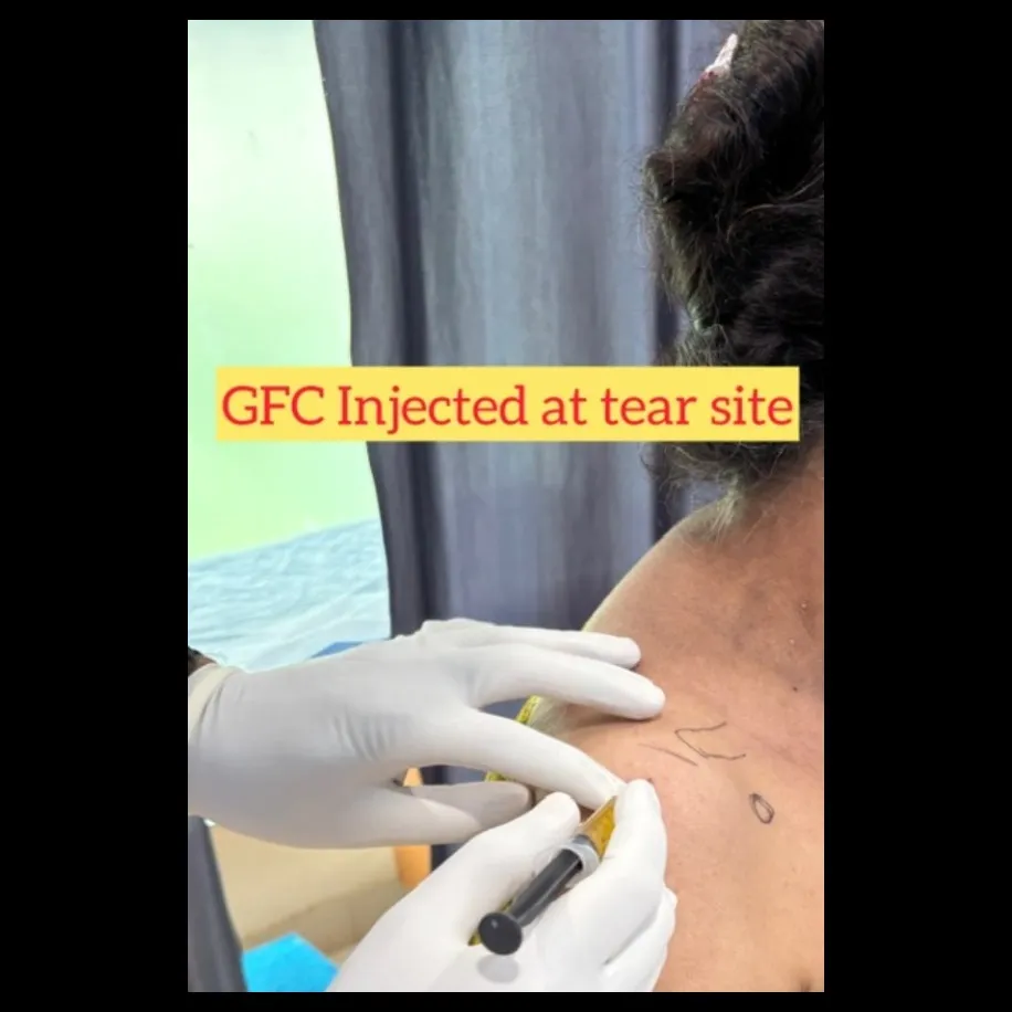 GFC INJECTION FOR SUPRASPINATUS PARTIAL TEAR