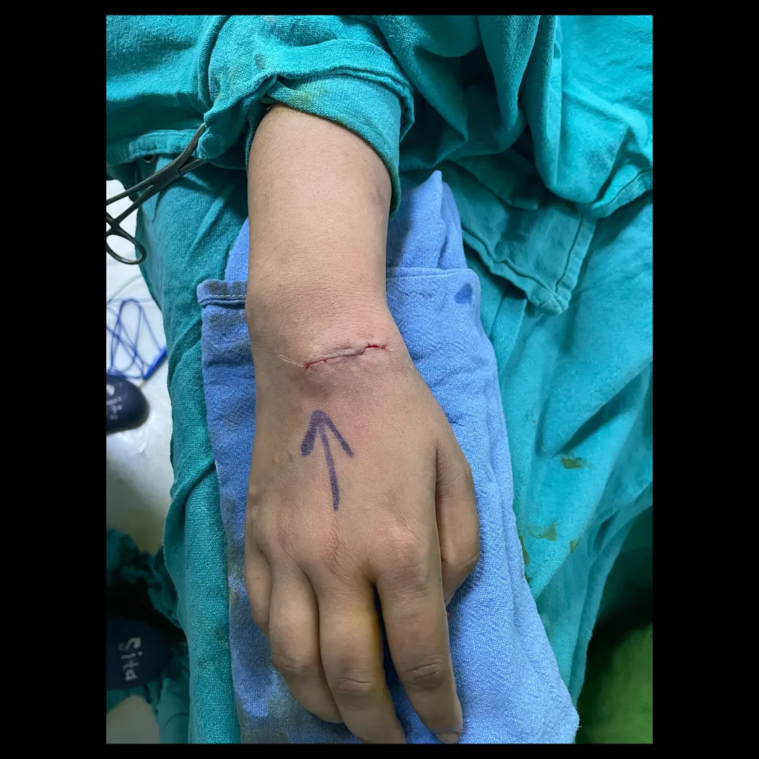 PAINFUL WRIST GANGLION EXCISION DONE