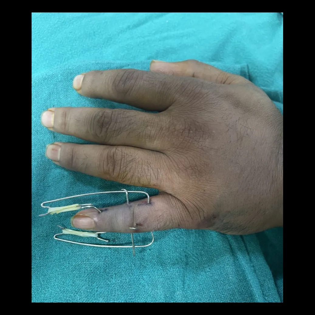 Suzuki Frame for Finger fracture