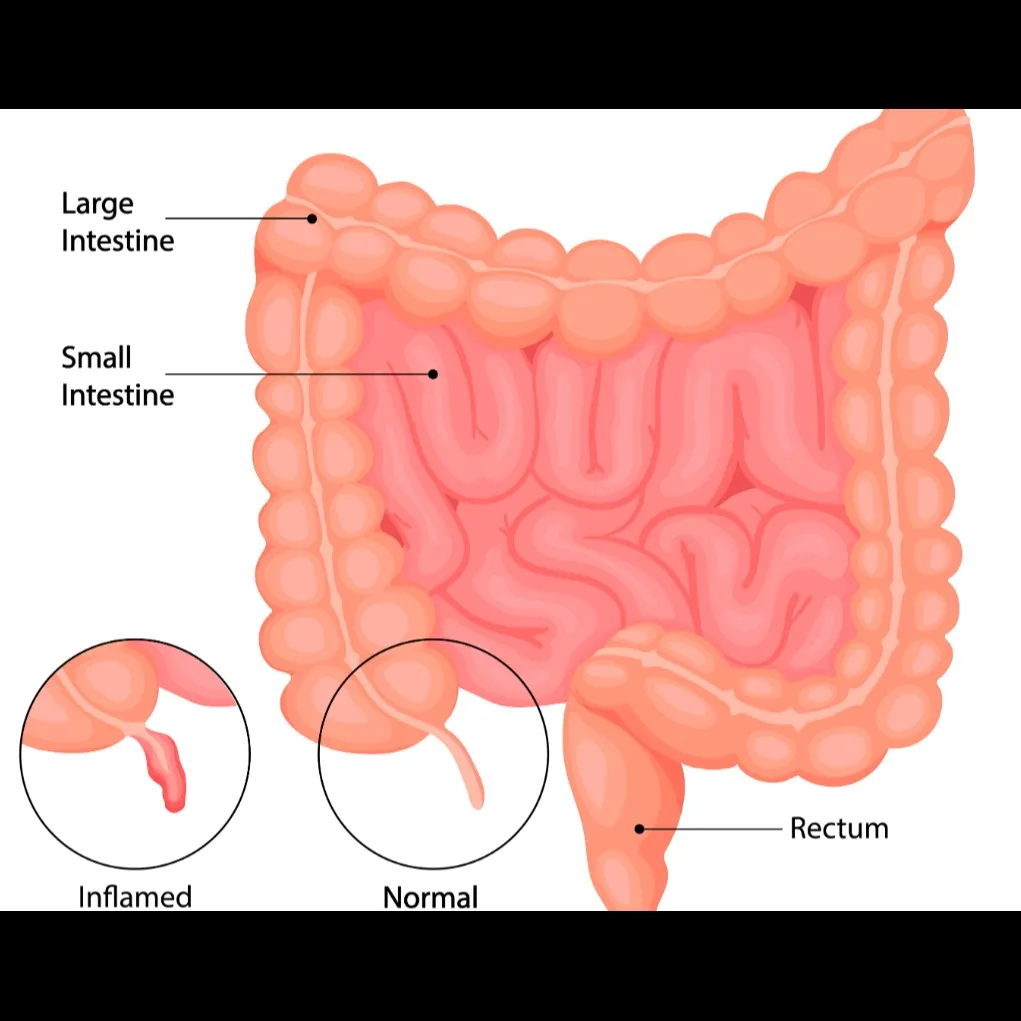 Appendix Surgery in Kolathur, Chennai – Prompt Relief from Abdominal Pain