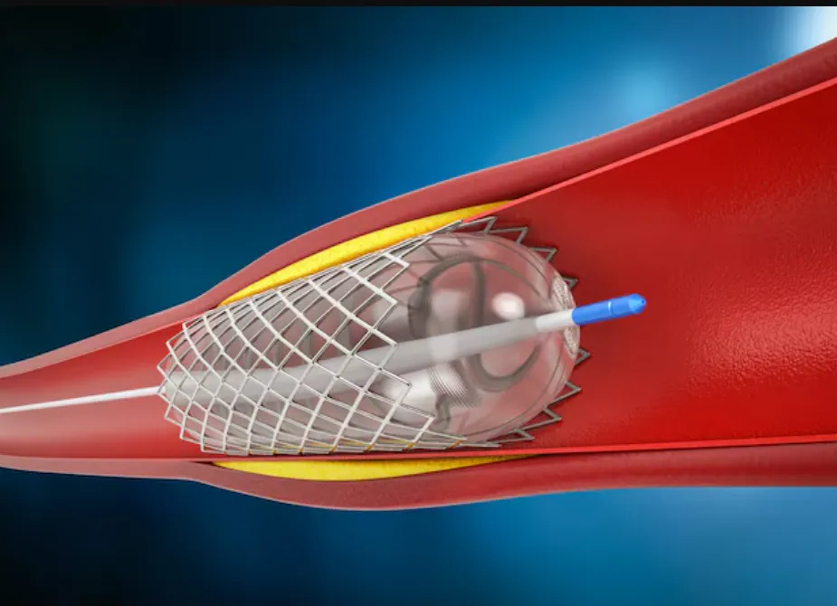 Angioplasty Procedure in Pune – A Timely Step to Restore Blood Flow