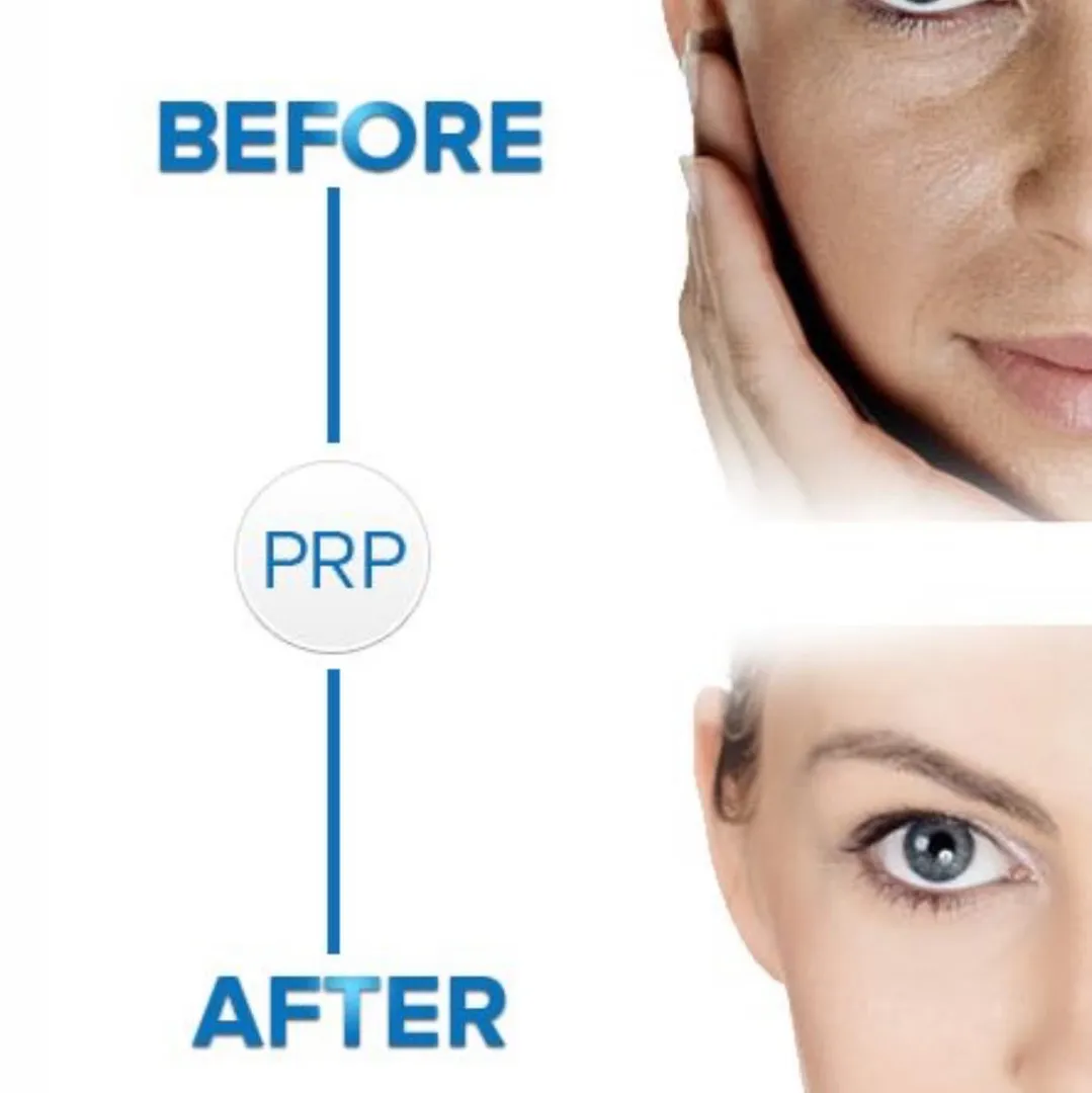 PRP is best and safe therapy for skin and hair
it gives natural glow with reduce dark spot scar fine...