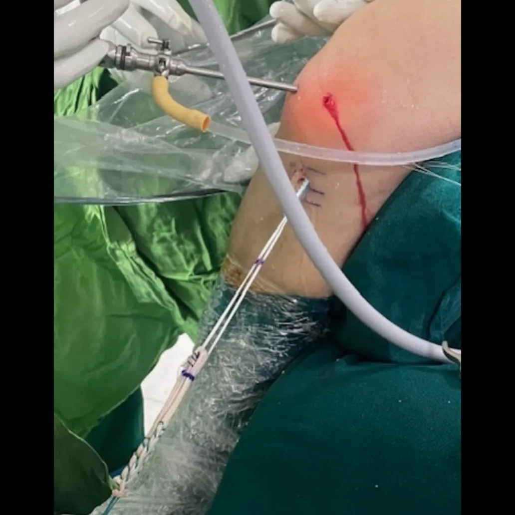ARTHROSCOPIC ACL RECONSTRUCTION DONE USING HAMSTRING GRAFT