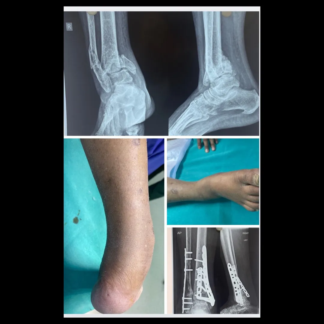 Complex malunited ankle fracture operated successfully
