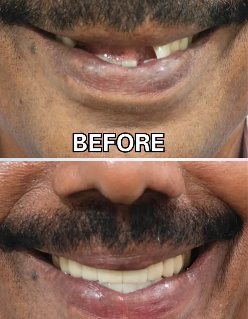 Zirconium crowns & bridges