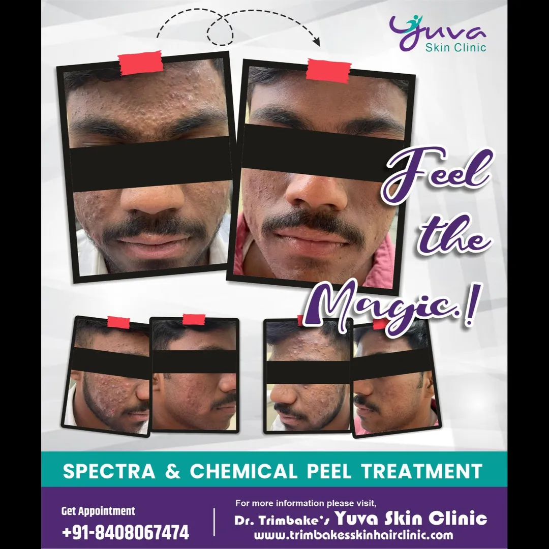 Feel the magic..
When it comes to refreshing your skin, chemical peel and spectra laser are two of t...