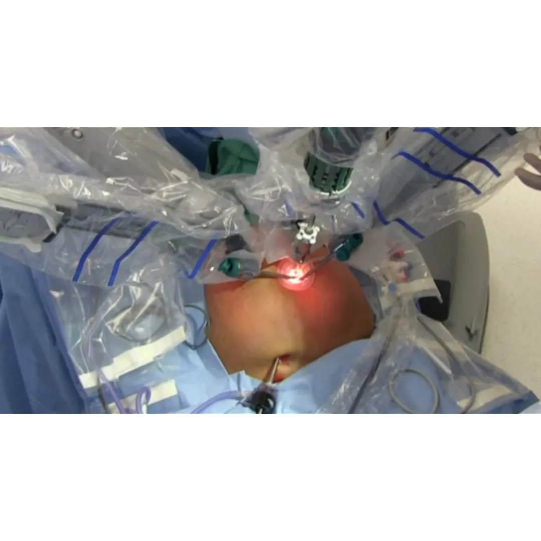 Robotic Hiatus Hernia Surgery for GERD in Yeshwantpur – Relief Without Compromise