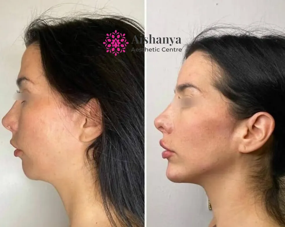 Best Jawline Fillers Treatment in Delhi NCR and Janakpuri and Dwarka