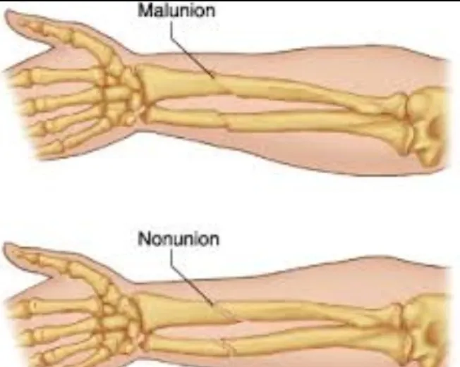 Nonunion and Malunion Treatment in Pimpri-Chinchwad
