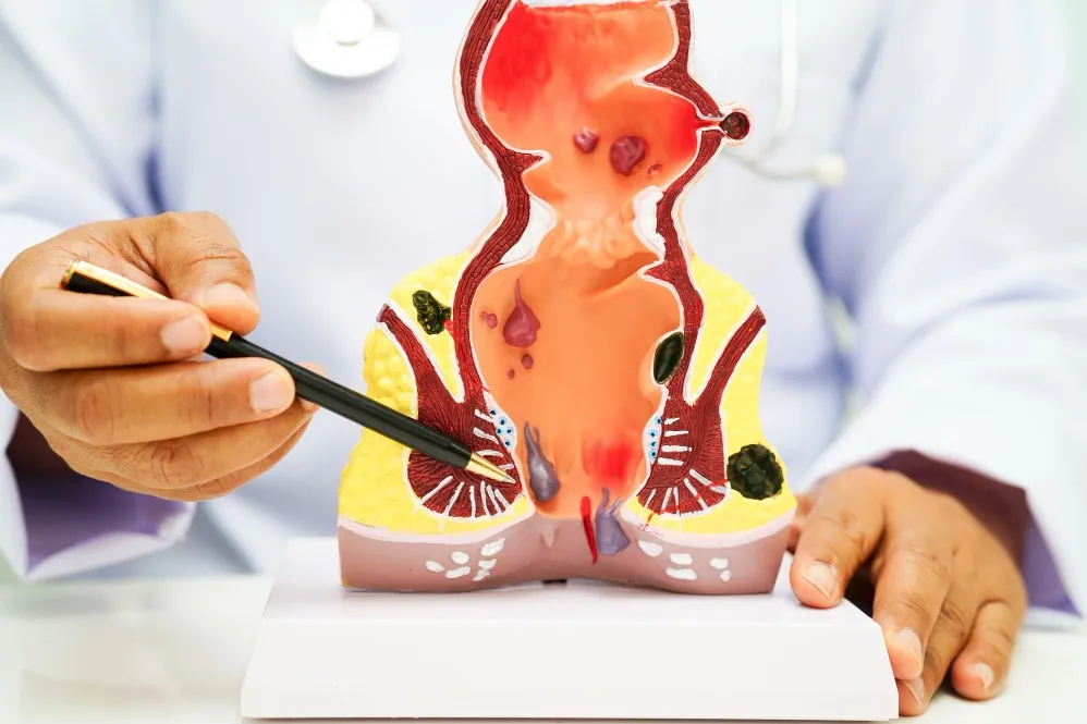 External Hemorrhoids Removal in Byculla – Gentle and Effective Procedures