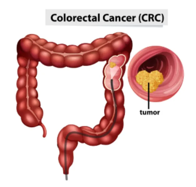 Colon Cancer Screening in Mumbai
