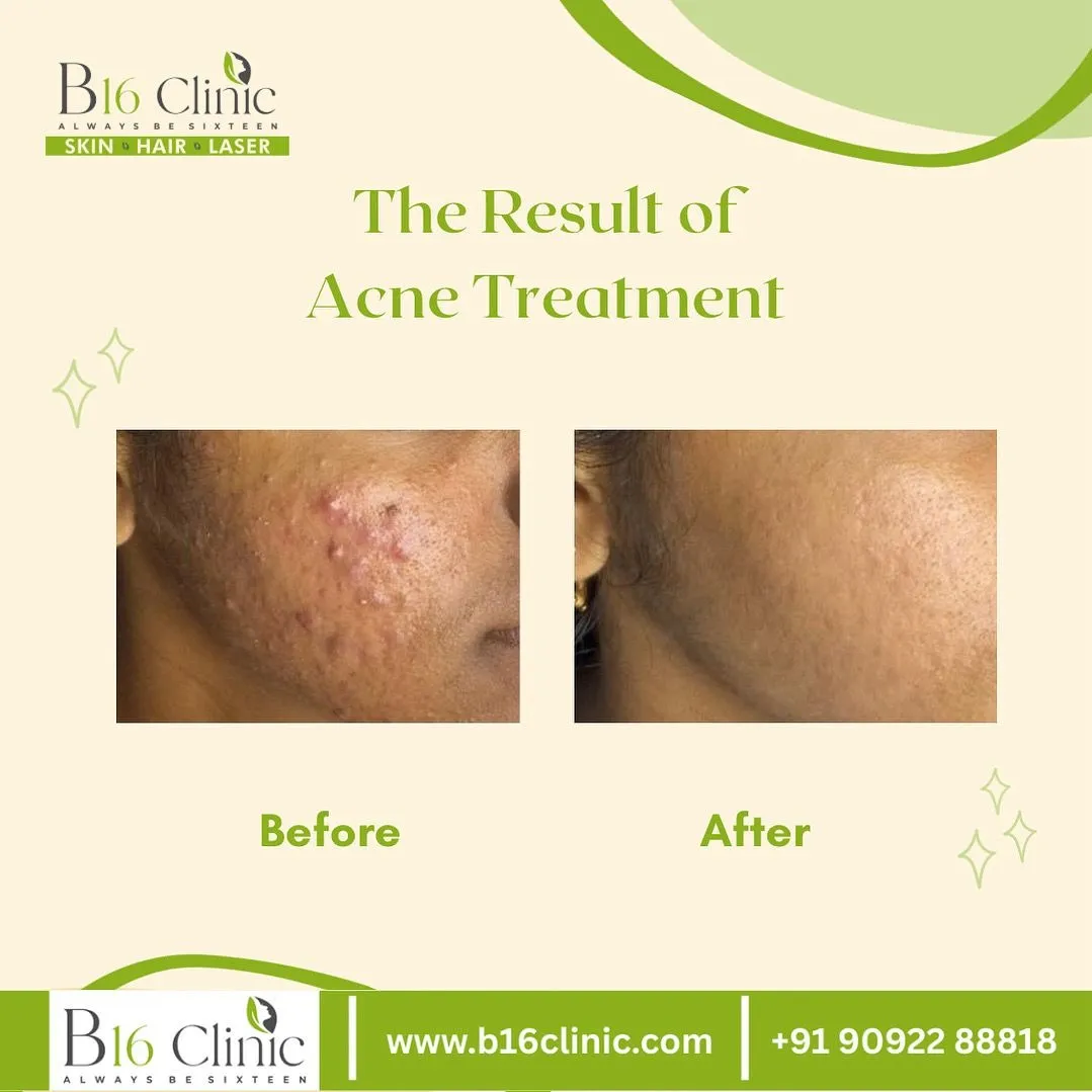 Best Acne Treatment in Coimbatore β B16 Clinic