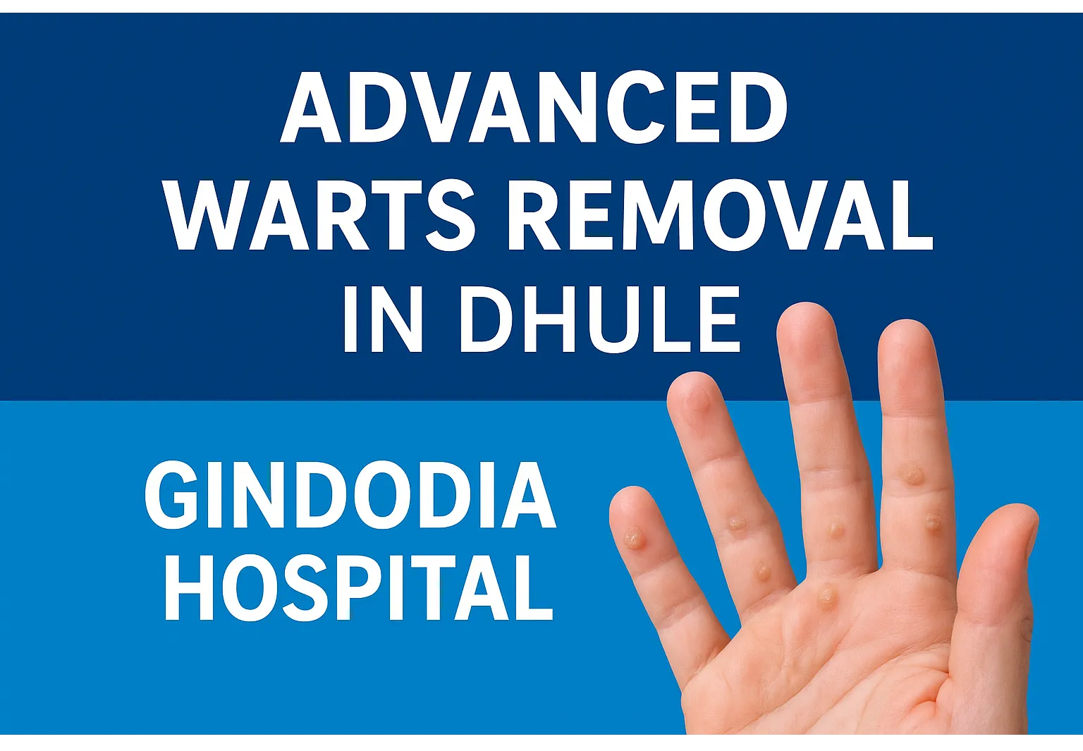 Gindodia Hospital – Advanced Warts Removal in Dhule