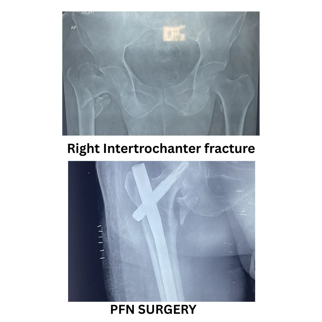 PFN surgery for right hip fracture