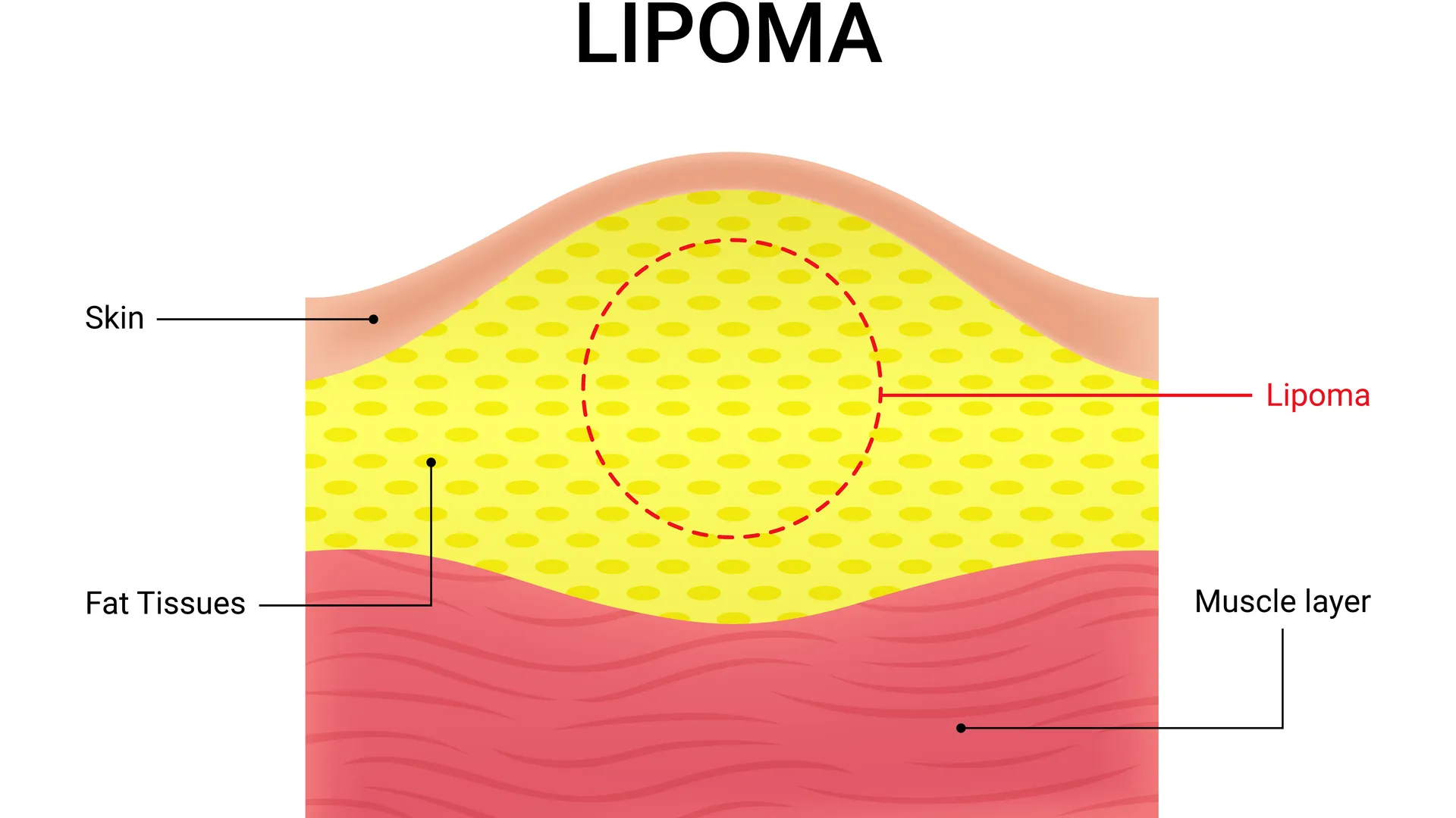 Lipoma and Sebaceous Cyst Removal in Kolathur, Chennai – Simple Procedures, Permanent Relief