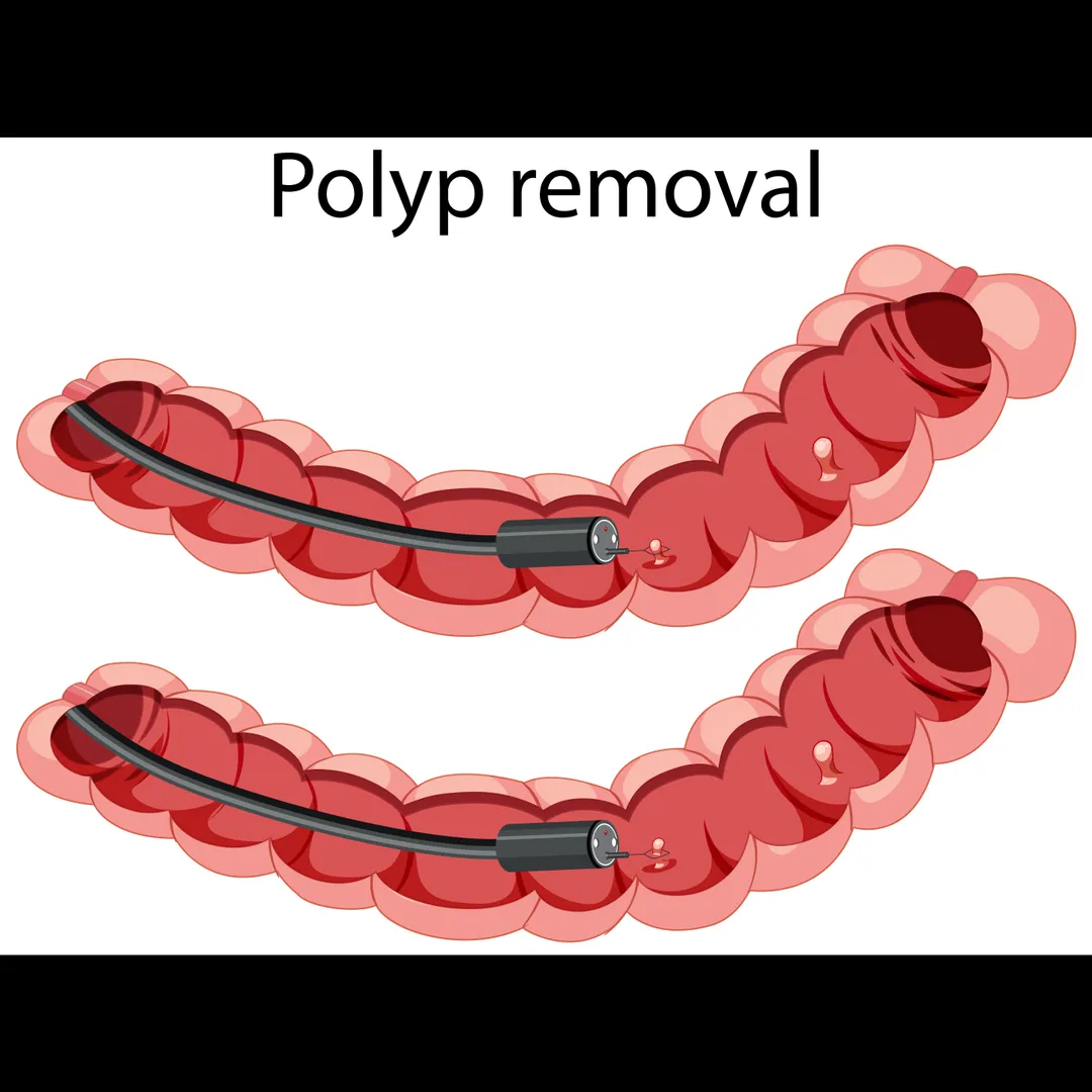 Colonic Polyps Removal in Mumbai