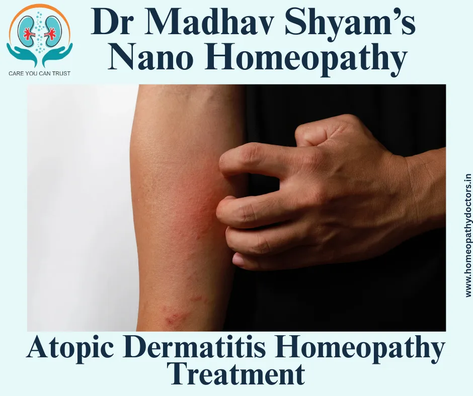Common Homeopathic Remedies for Atopic Dermatitis
Sulphur: This remedy is often used for intensely ...