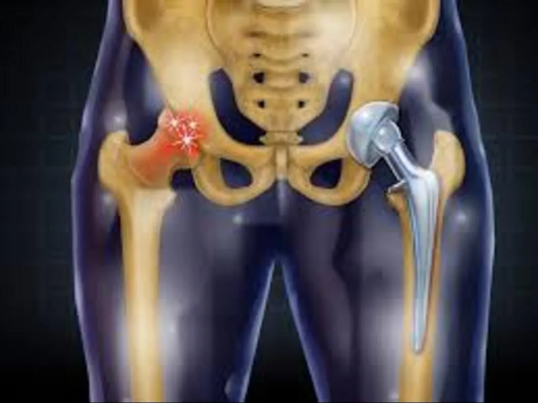 Choosing Hip Replacement in Nagpur