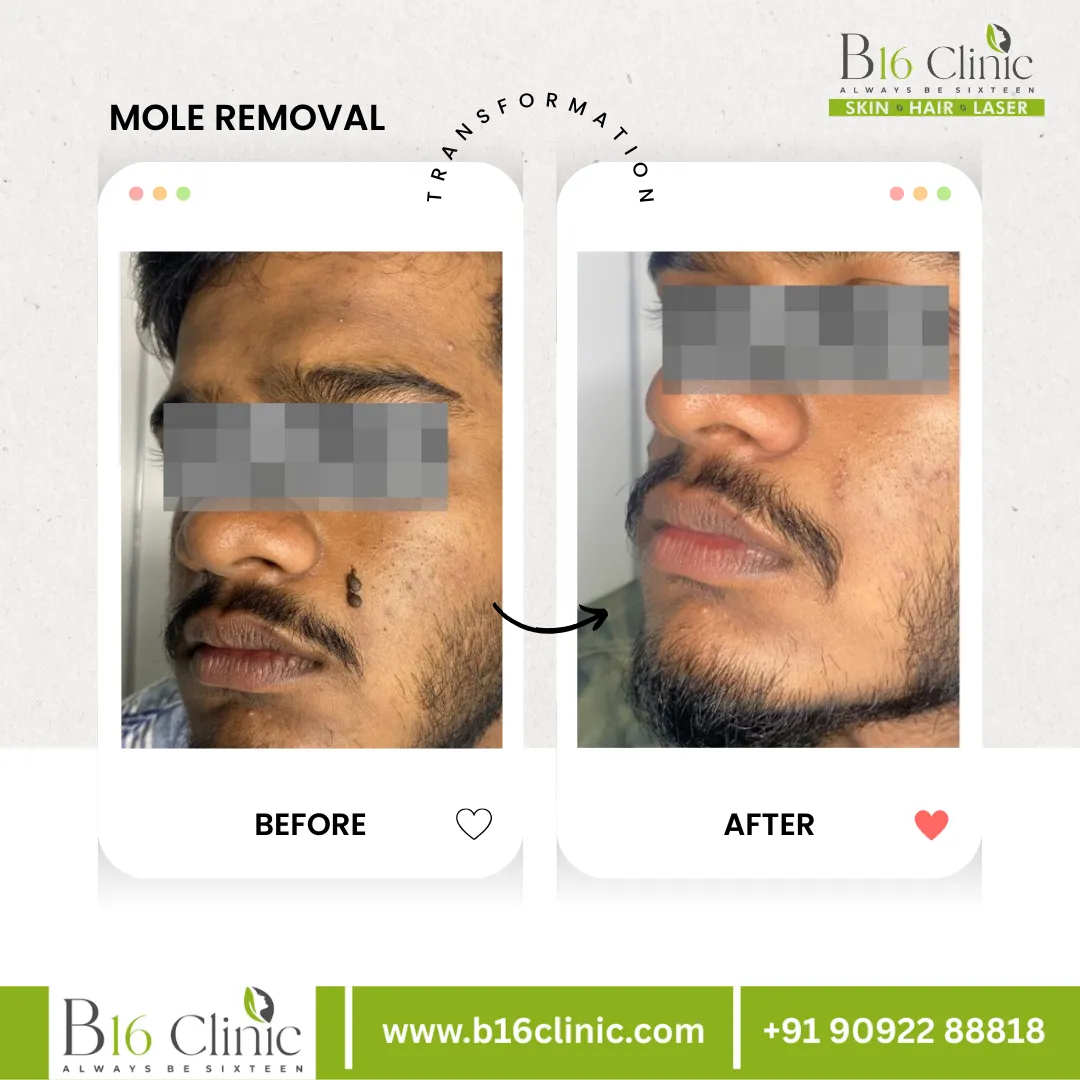 Mole Removal Clinic in Coimbatore
