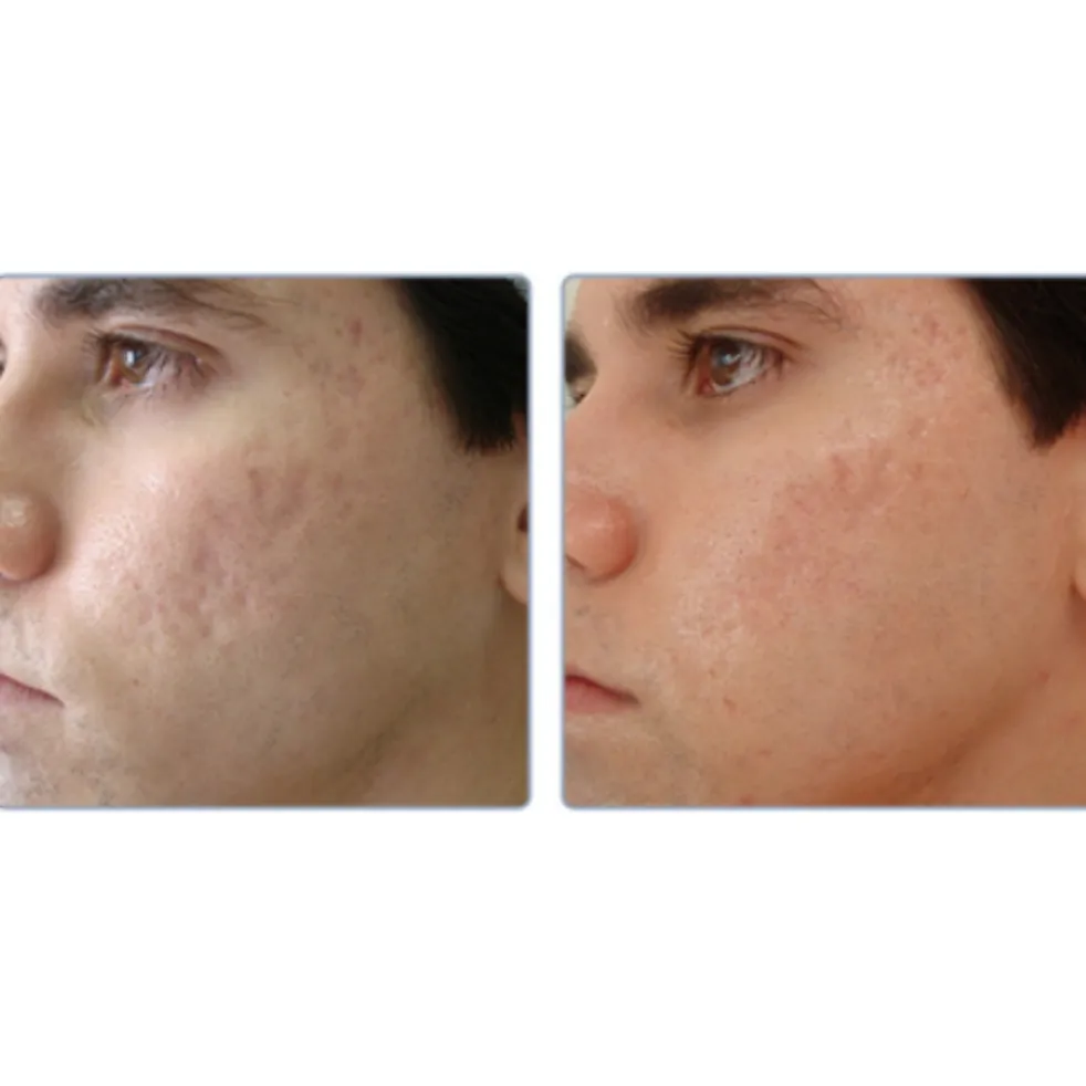 Laser for Acne Scars in Chennai – Restore Clear and Confident Skin