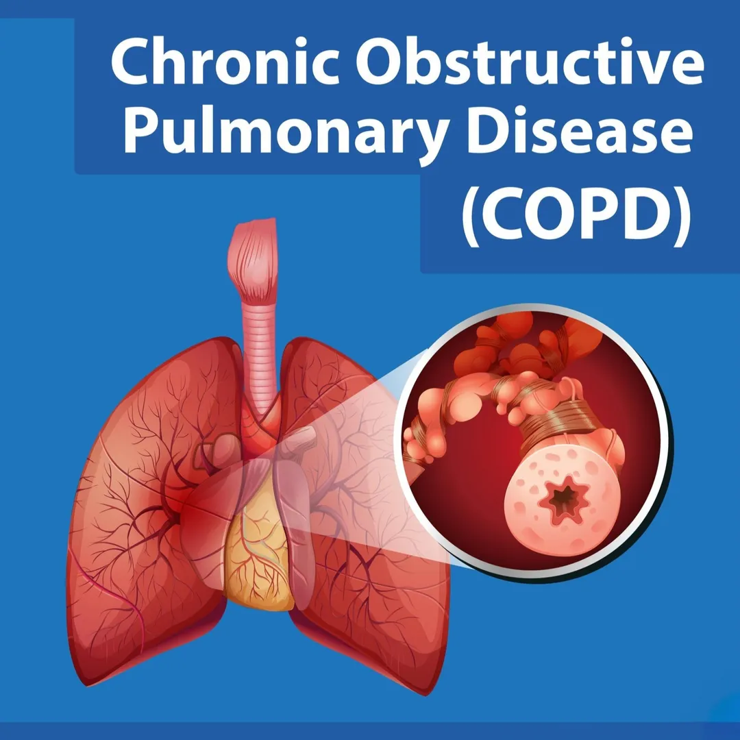 COPD Treatment in Jaipur – Managing Chronic Breathing Difficulties