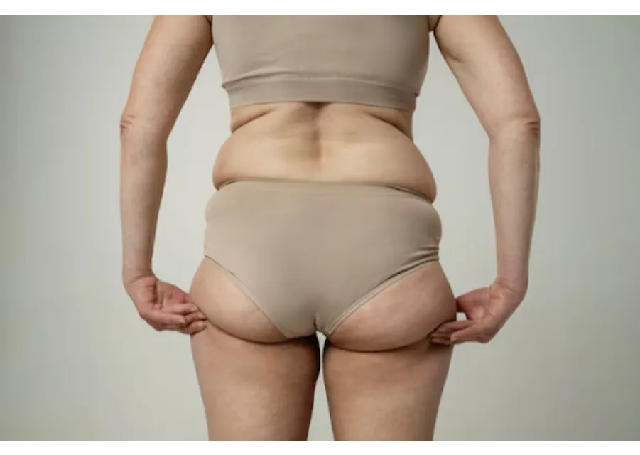 Buttock Implants Surgery in Bangalore – Enhance Your Curves