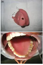 Rebuilding Smiles After Mucormycosis ✨