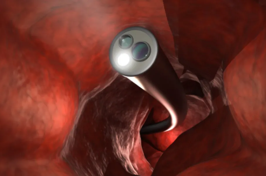 Endoscopic Submucosal Dissection (ESD) in Mumbai