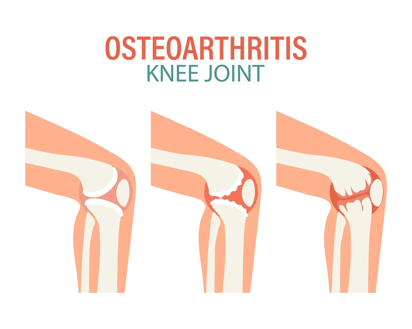 Osteoarthritis Treatment in Kottivakkam – Regain Comfort and Flexibility