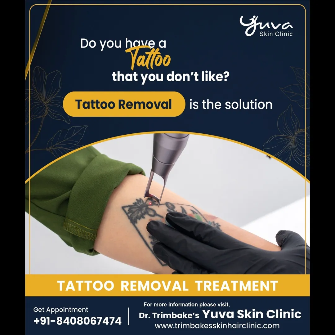 Tattoo Removal Treatment
Getting bored of your permanent tattoo... Want to get a new tattoo inked on...