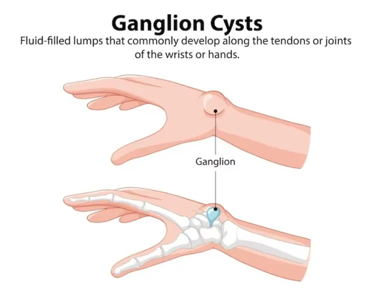 Ganglion Cyst in Hand and Wrist – Removal and Relief in Mumbai