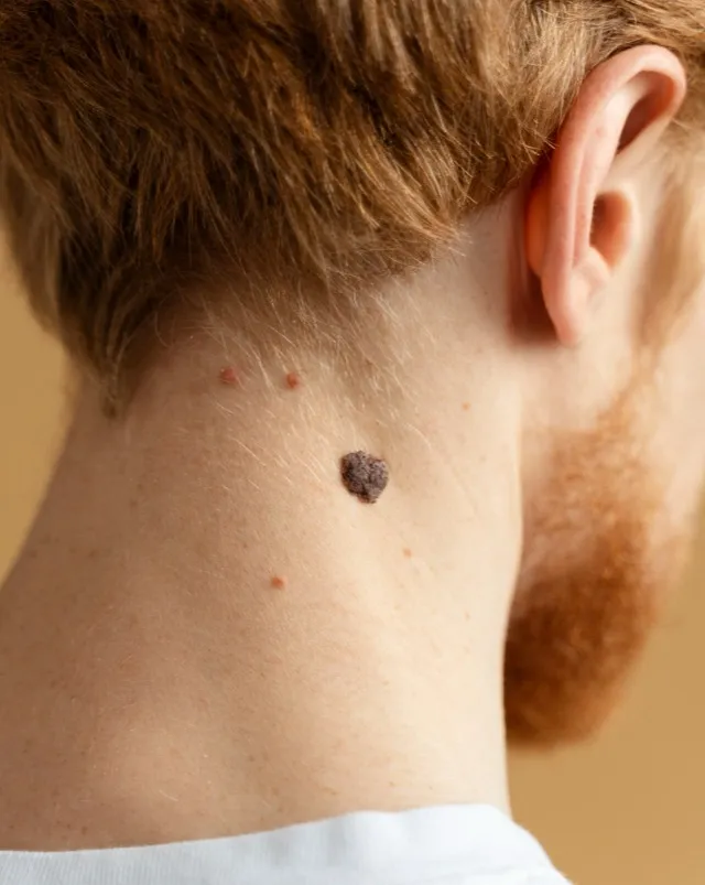 Melanoma Care in Mumbai – Detecting and Treating Aggressive Skin Cancer