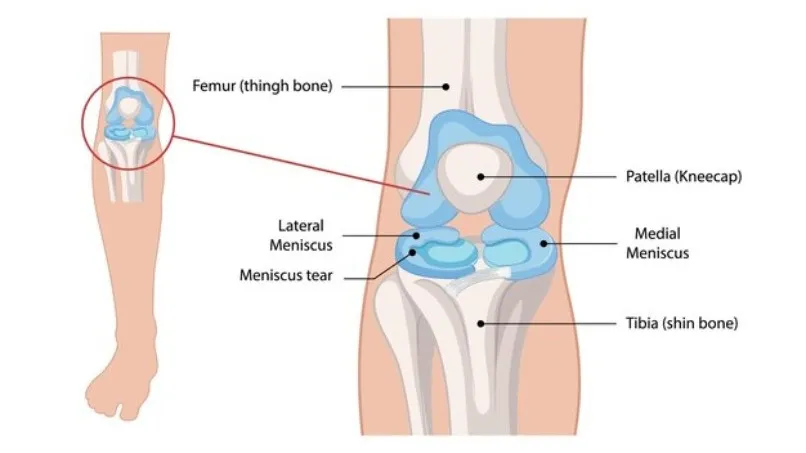Meniscus Surgery in Noida – Effective Relief for Knee Injuries