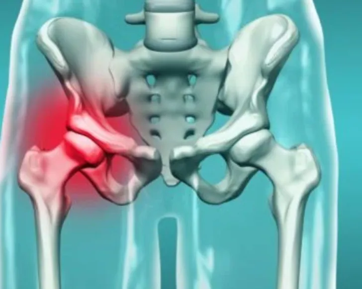 AVN Treatment in Nagpur – Restore Hip Function with Timely Care